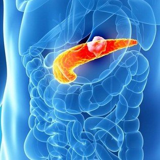 3d rendered illustration of the male pancreas - cancer