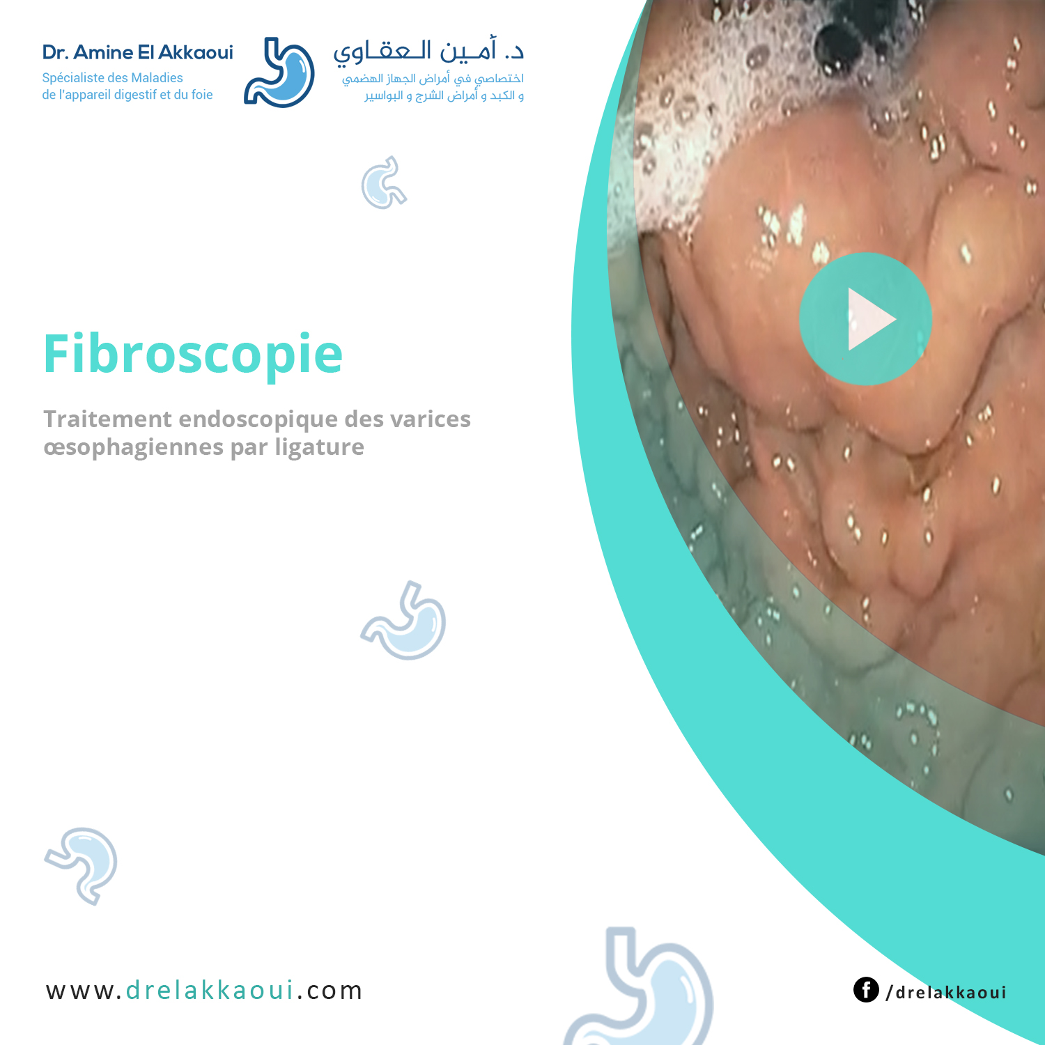 Traitement endoscopique des varices œsophagiennes par ligature Dr
